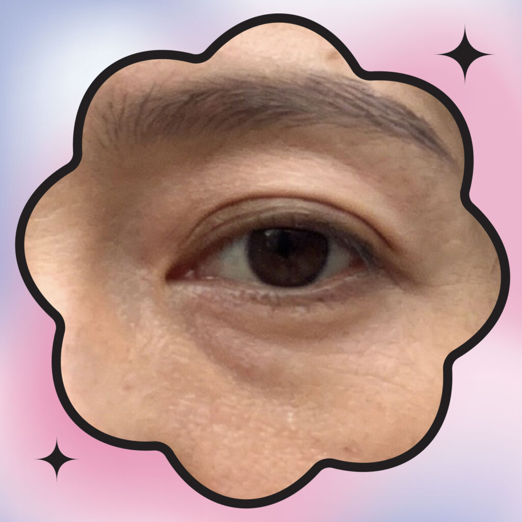 淚溝型眼袋